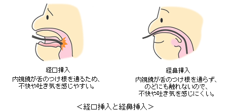 経鼻胃内視鏡