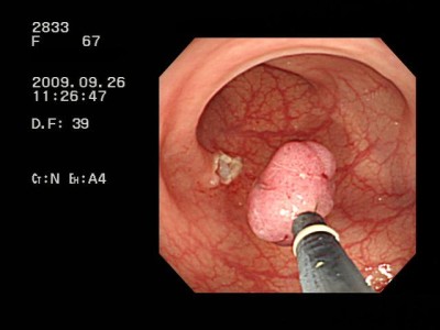 ポリープ回収